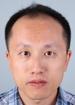 Before Hair Transplant&nbsp;Front